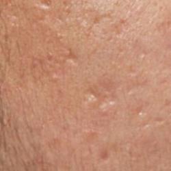 Example of acne